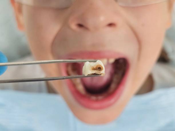 Best Emergency Root Canal Therapy in Willow Park, TX
